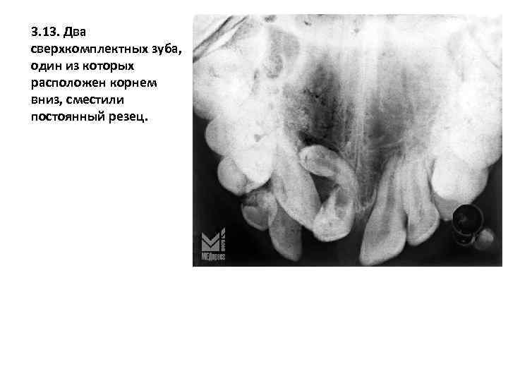 3. 13. Два сверхкомплектных зуба, один из которых расположен корнем вниз, сместили постоянный резец.
