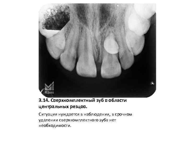 3. 14. Сверхкомплектный зуб в области центральных резцов. Ситуация нуждается в наблюдении, в срочном