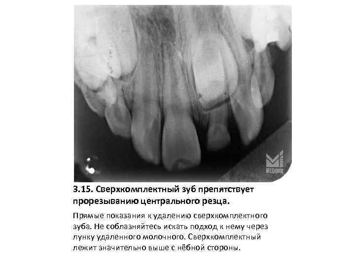 3. 15. Сверхкомплектный зуб препятствует прорезыванию центрального резца. Прямые показания к удалению сверхкомплектного зуба.