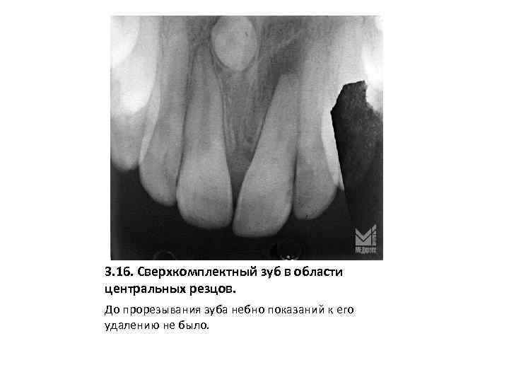 3. 16. Сверхкомплектный зуб в области центральных резцов. До прорезывания зуба небно показаний к