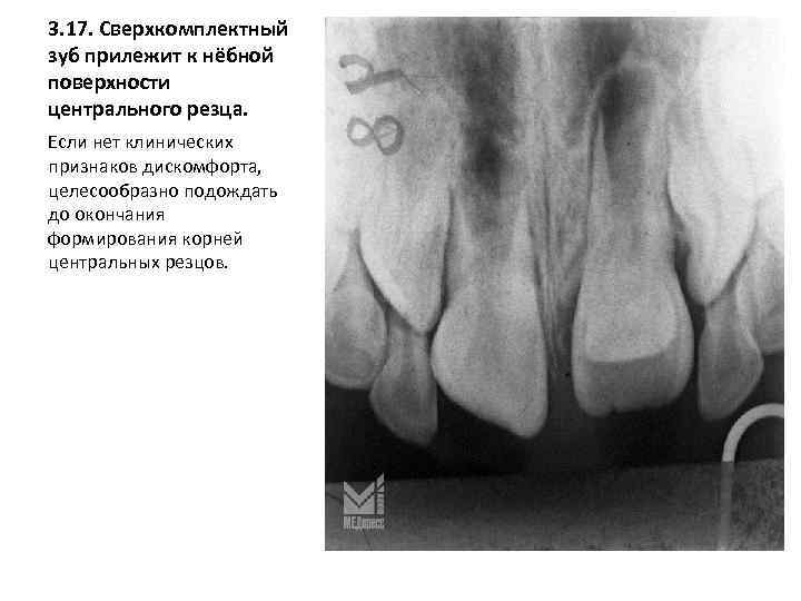 3. 17. Сверхкомплектный зуб прилежит к нёбной поверхности центрального резца. Если нет клинических признаков