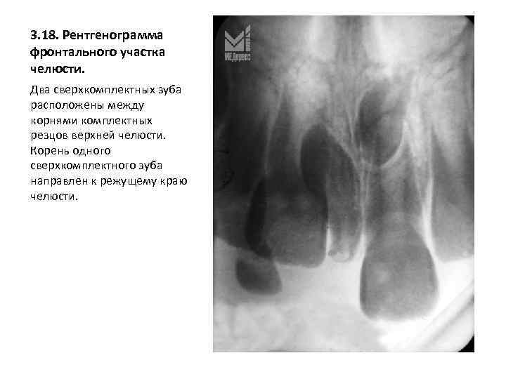 3. 18. Рентгенограмма фронтального участка челюсти. Два сверхкомплектных зуба расположены между корнями комплектных резцов