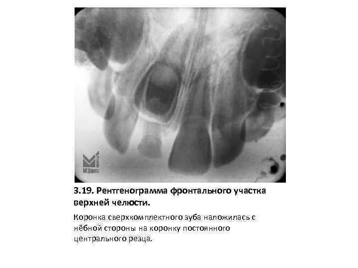 3. 19. Рентгенограмма фронтального участка верхней челюсти. Коронка сверхкомплектного зуба наложилась с нёбной стороны