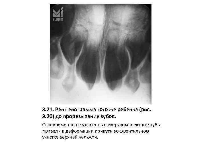 3. 21. Рентгенограмма того же ребенка (рис. 3. 20) до прорезывания зубов. Своевременно не