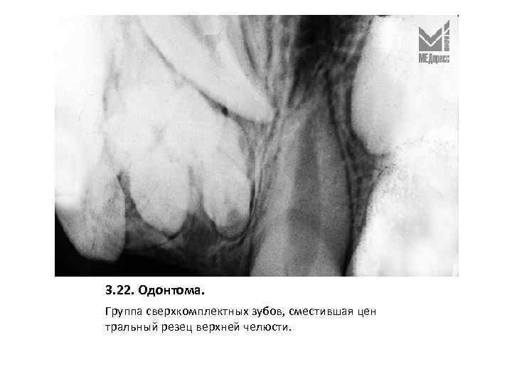 3. 22. Одонтома. Группа сверхкомплектных зубов, сместившая цен тральный резец верхней челюсти. 