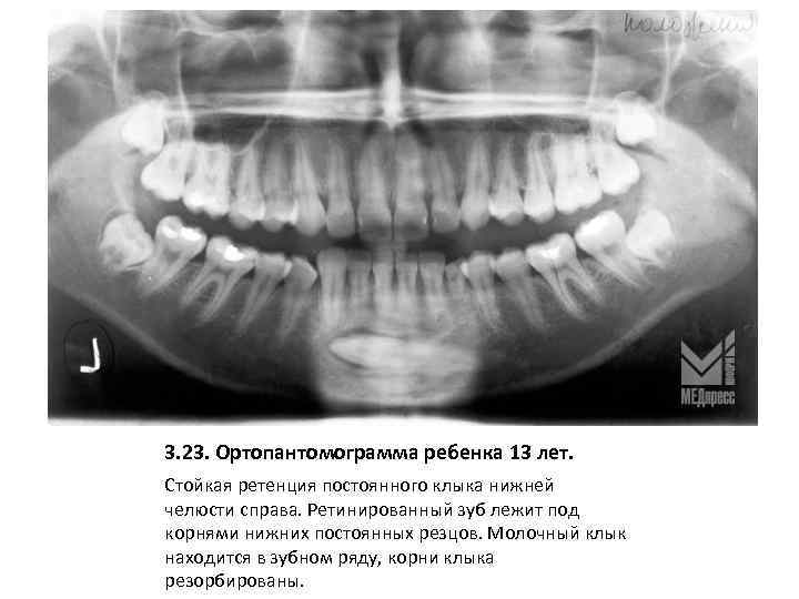 3. 23. Ортопантомограмма ребенка 13 лет. Стойкая ретенция постоянного клыка нижней челюсти справа. Ретинированный