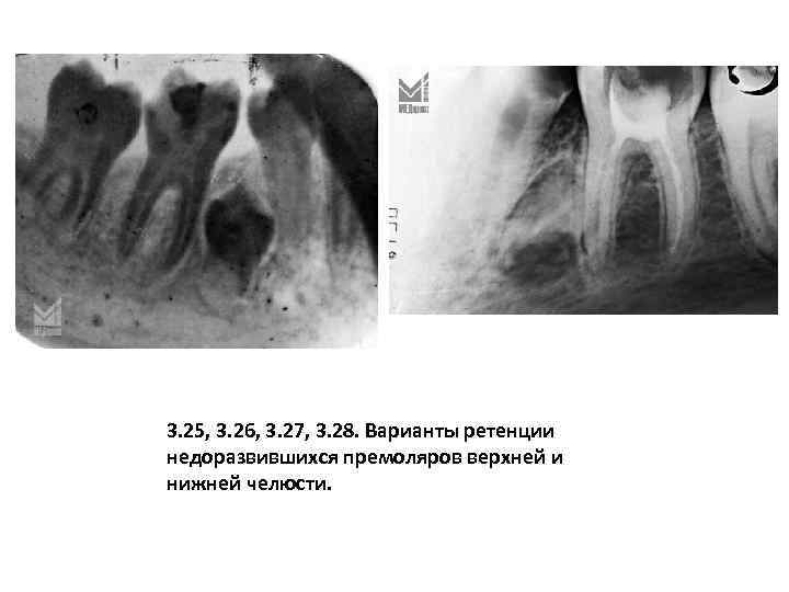 3. 25, 3. 26, 3. 27, 3. 28. Варианты ретенции недоразвившихся премоляров верхней и