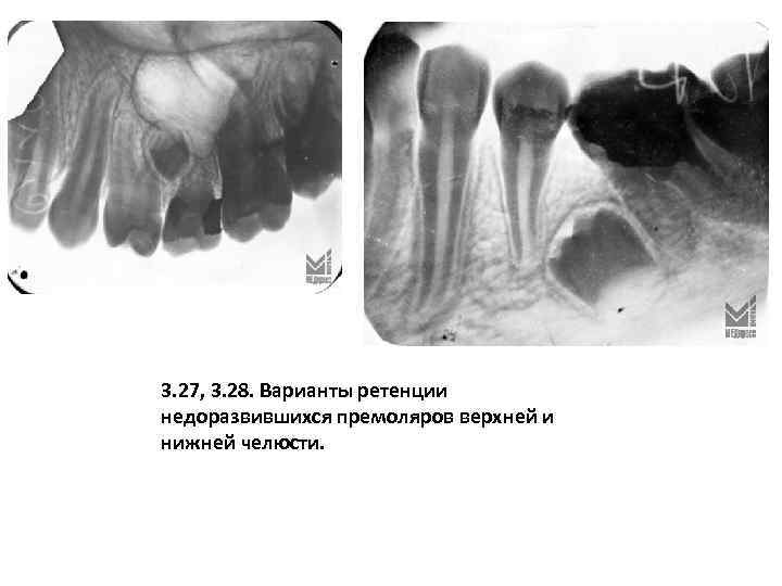3. 27, 3. 28. Варианты ретенции недоразвившихся премоляров верхней и нижней челюсти. 