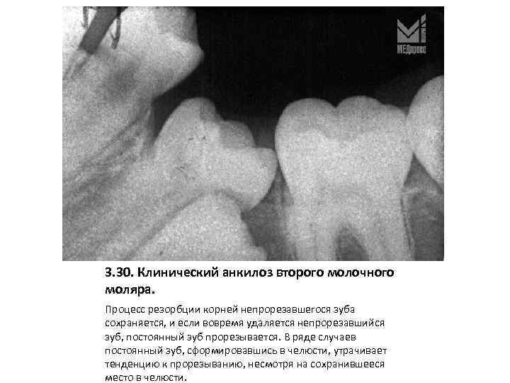 3. 30. Клинический анкилоз второго молочного моляра. Процесс резорбции корней непрорезавшегося зуба сохраняется, и