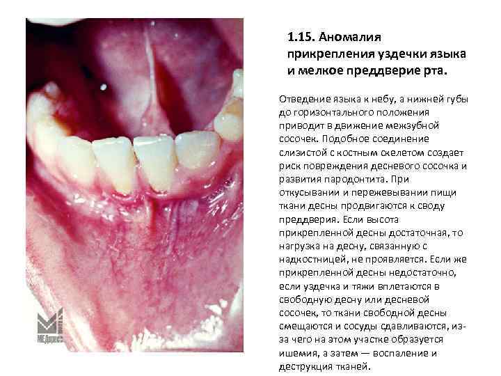 1. 15. Аномалия прикрепления уздечки языка и мелкое преддверие рта. Отведение языка к небу,