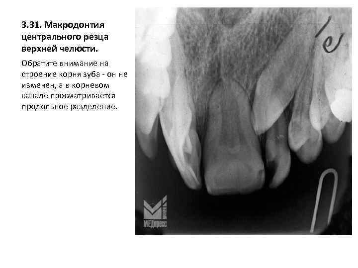 3. 31. Макродонтия центрального резца верхней челюсти. Обратите внимание на строение корня зуба -