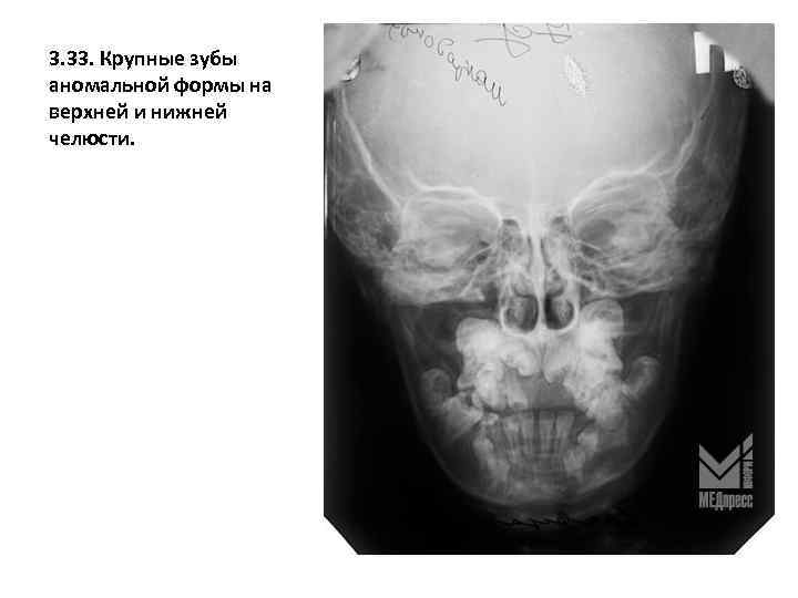 3. 33. Крупные зубы аномальной формы на верхней и нижней челюсти. 