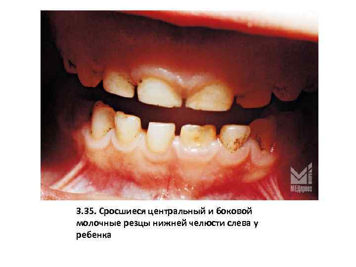 3. 35. Сросшиеся центральный и боковой молочные резцы нижней челюсти слева у ребенка 