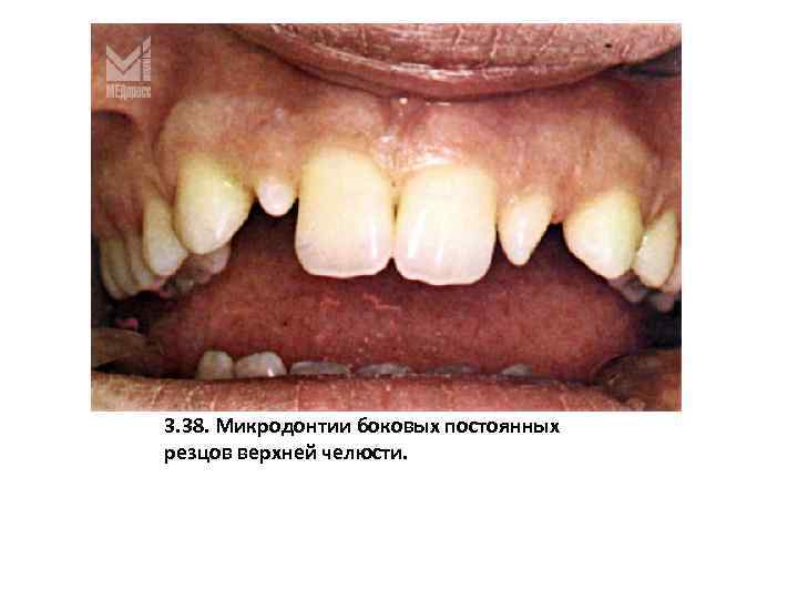 3. 38. Микродонтии боковых постоянных резцов верхней челюсти. 