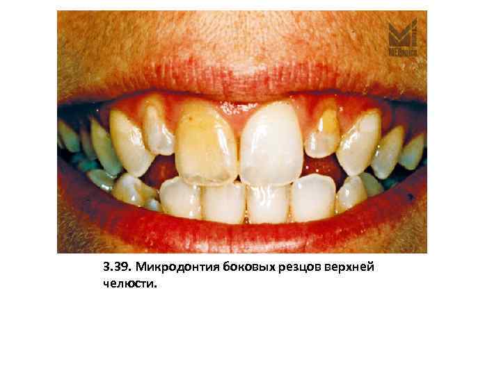 3. 39. Микродонтия боковых резцов верхней челюсти. 