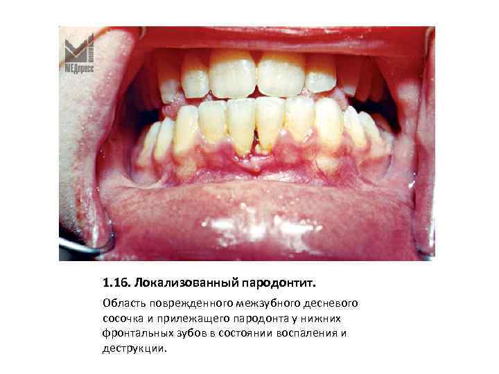 1. 16. Локализованный пародонтит. Область поврежденного межзубного десневого сосочка и прилежащего пародонта у нижних