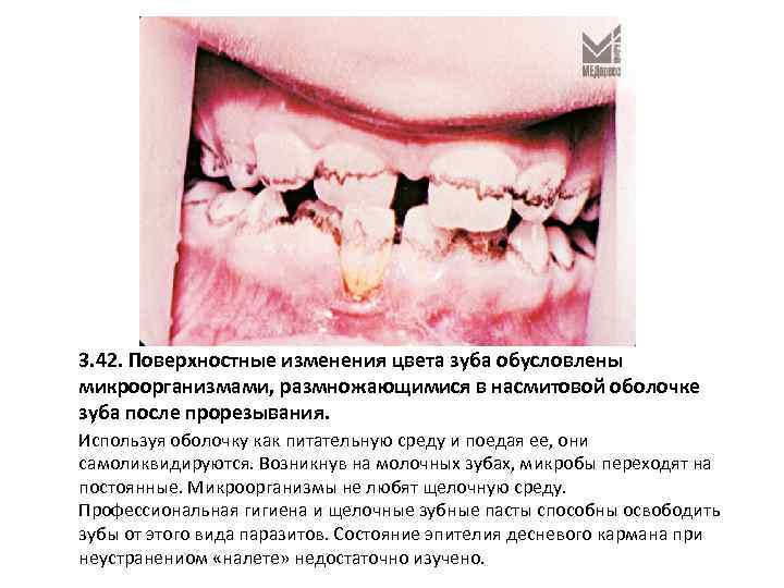 3. 42. Поверхностные изменения цвета зуба обусловлены микроорганизмами, размножающимися в насмитовой оболочке зуба после