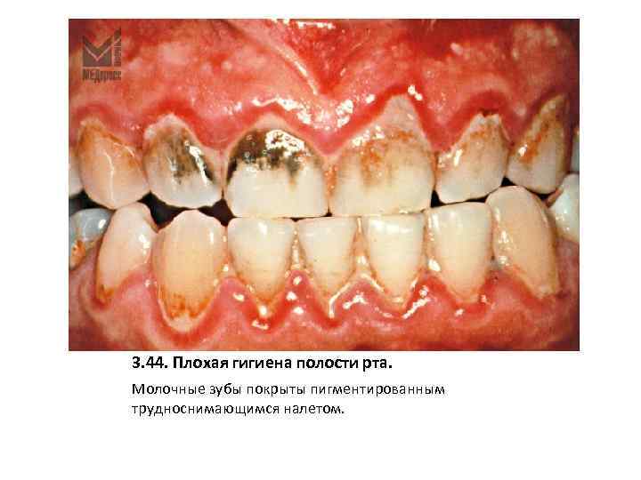 3. 44. Плохая гигиена полости рта. Молочные зубы покрыты пигментированным трудноснимающимся налетом. 