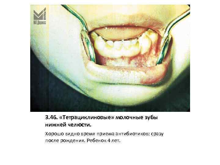 3. 46. «Тетрациклиновые» молочные зубы нижней челюсти. Хорошо видно время приема антибиотиков: сразу после