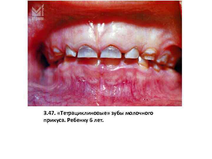3. 47. «Тетрациклиновые» зубы молочного прикуса. Ребенку 6 лет. 