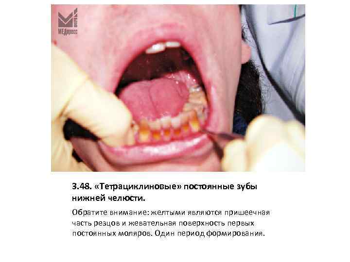 3. 48. «Тетрациклиновые» постоянные зубы нижней челюсти. Обратите внимание: желтыми являются пришеечная часть резцов