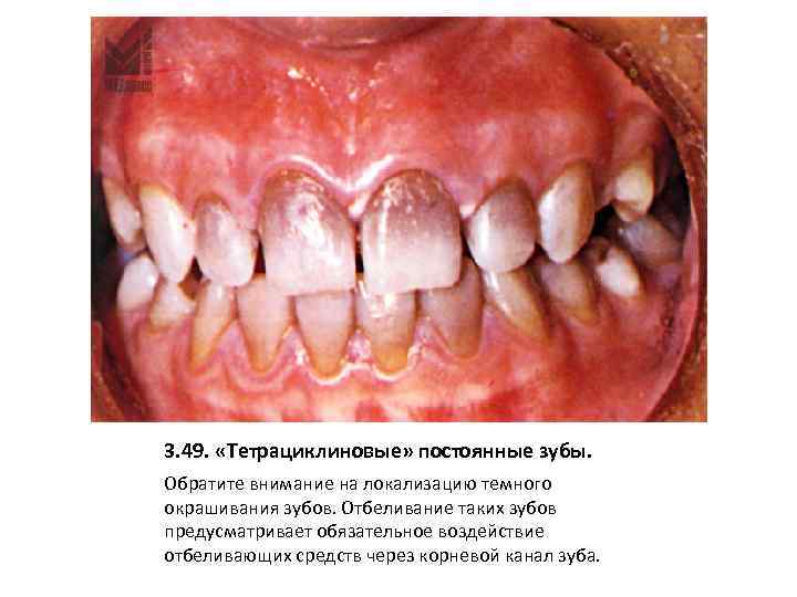 3. 49. «Тетрациклиновые» постоянные зубы. Обратите внимание на локализацию темного окрашивания зубов. Отбеливание таких