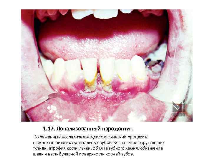 1. 17. Локализованный пародонтит. Выраженный воспалительно-дистрофический процесс в пародонте нижних фронтальных зубов. Воспаление окружающих