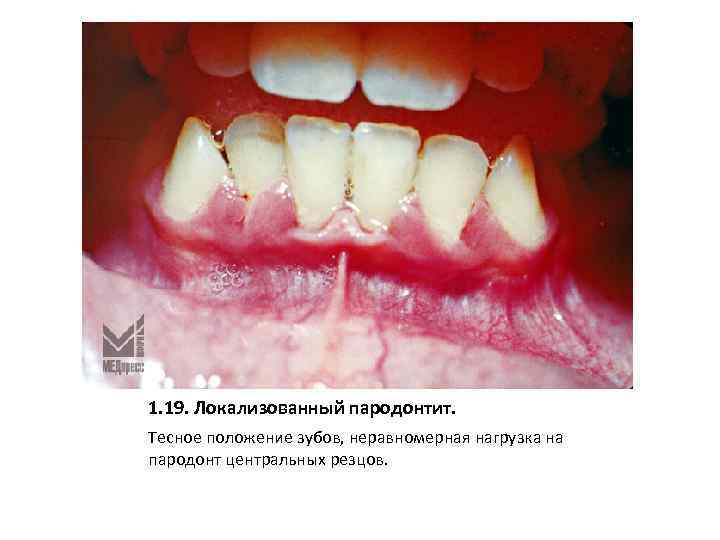 1. 19. Локализованный пародонтит. Тесное положение зубов, неравномерная нагрузка на пародонт центральных резцов. 