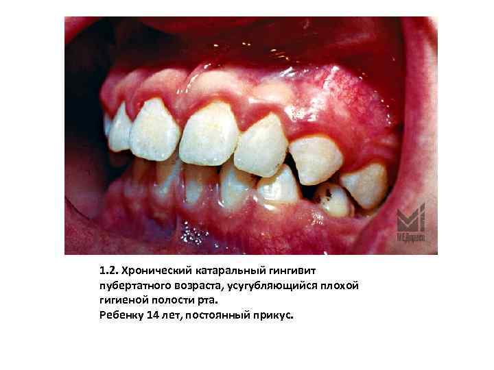 1. 2. Хронический катаральный гингивит пубертатного возраста, усугубляющийся плохой гигиеной полости рта. Ребенку 14