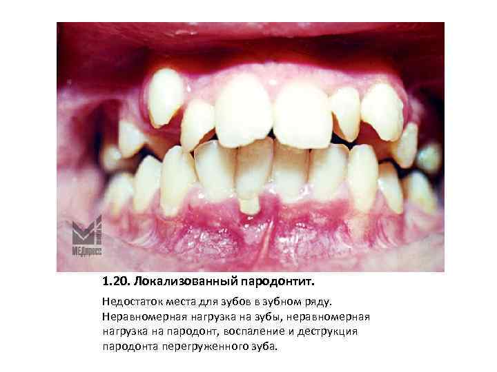 1. 20. Локализованный пародонтит. Недостаток места для зубов в зубном ряду. Неравномерная нагрузка на