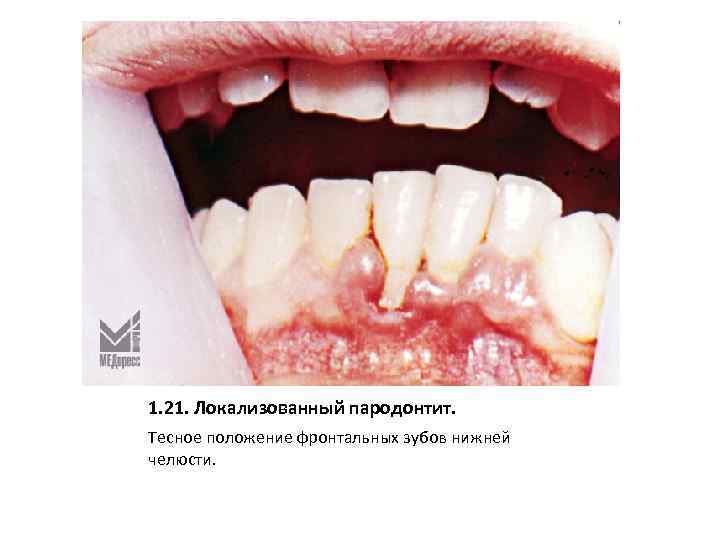 1. 21. Локализованный пародонтит. Тесное положение фронтальных зубов нижней челюсти. 