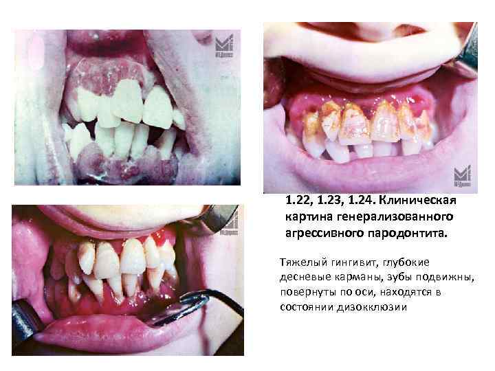 1. 22, 1. 23, 1. 24. Клиническая картина генерализованного агрессивного пародонтита. Тяжелый гингивит, глубокие