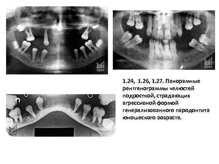 1. 24, 1. 26, 1. 27. Панорамные рентгенограммы челюстей подросткой, страдающих агрессивной формой генерализованного