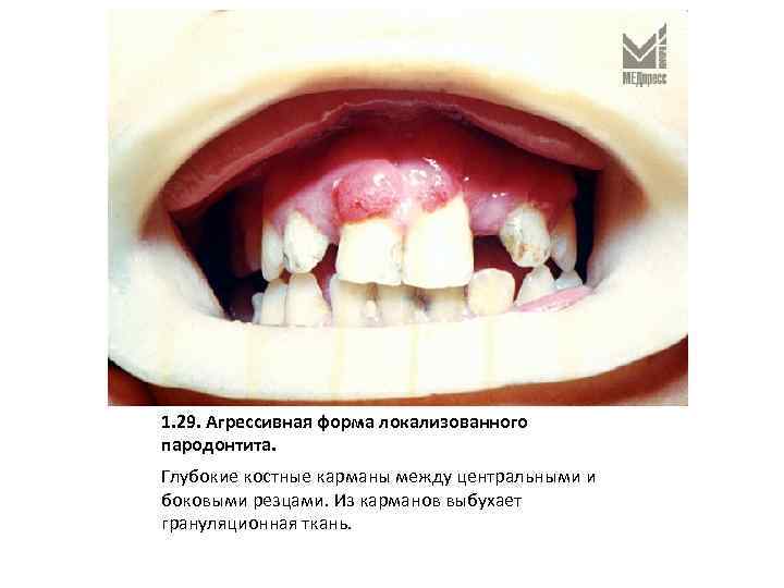 1. 29. Агрессивная форма локализованного пародонтита. Глубокие костные карманы между центральными и боковыми резцами.