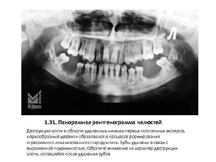 1. 31. Панорамная рентгенограмма челюстей Деструкция кости в области удаленных нижних первых постоянных моляров.