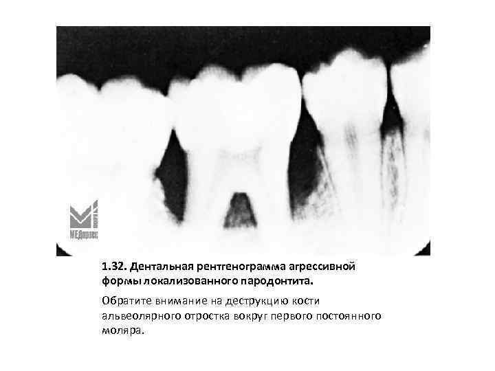 1. 32. Дентальная рентгенограмма агрессивной формы локализованного пародонтита. Обратите внимание на деструкцию кости альвеолярного