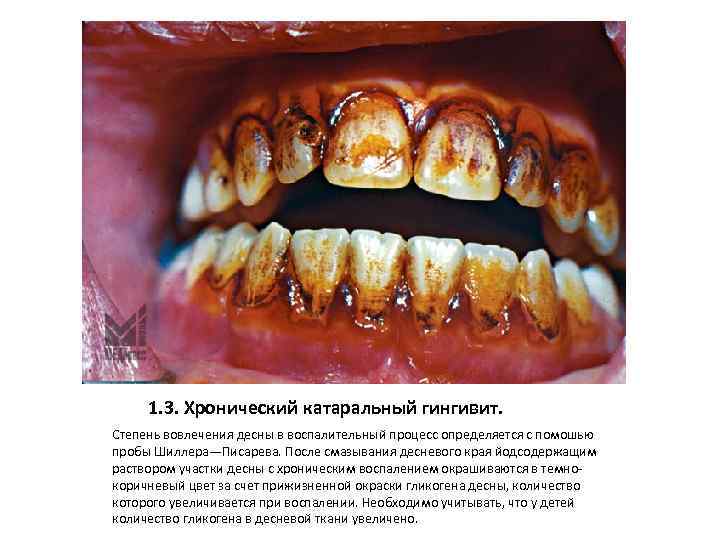 1. 3. Хронический катаральный гингивит. Степень вовлечения десны в воспалительный процесс определяется с помошью