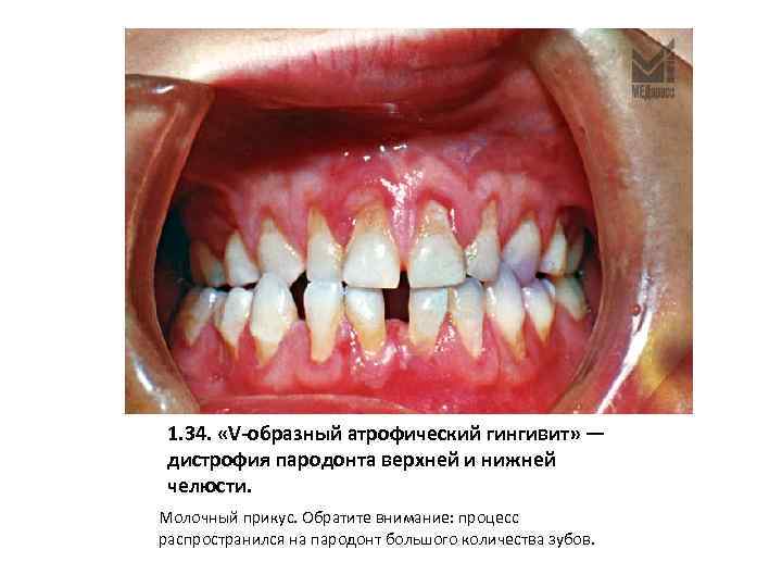1. 34. «V-образный атрофический гингивит» — дистрофия пародонта верхней и нижней челюсти. Молочный прикус.