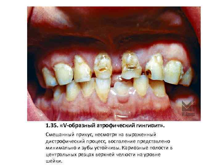 1. 35. «V-образный атрофический гингивит» . Смешанный прикус, несмотря на выраженный дистрофический процесс, воспаление