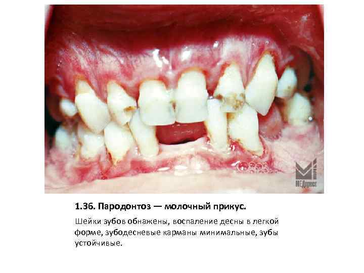 1. 36. Пародонтоз — молочный прикус. Шейки зубов обнажены, воспаление десны в легкой форме,