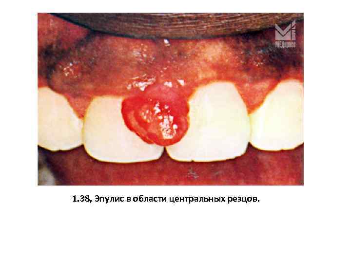 1. 38, Эпулис в области центральных резцов. 