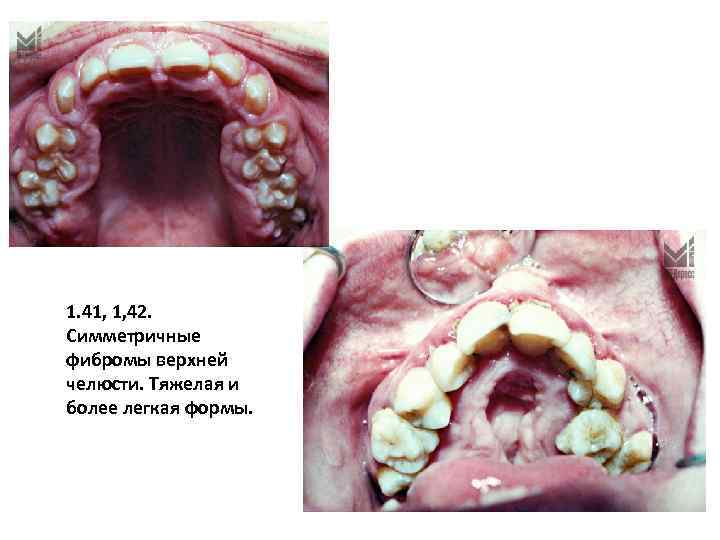 1. 41, 1, 42. Симметричные фибромы верхней челюсти. Тяжелая и более легкая формы. 