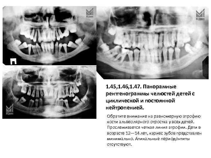 1. 45, 1. 46, 1. 47. Панорамные рентгенограммы челюстей детей с циклической и постоянной