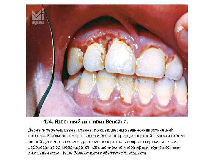 1. 4. Язвенный гингивит Венсана. Десна гиперемирована, отечна, по краю десны язвенно-некротический процесс. В