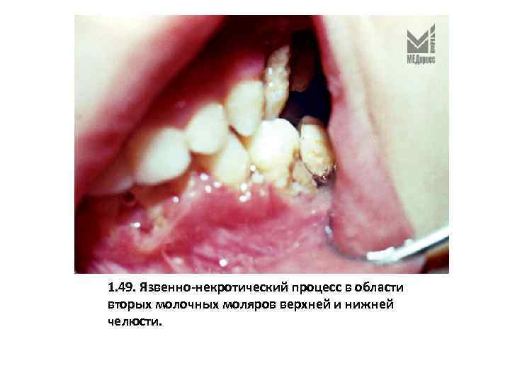 1. 49. Язвенно-некротический процесс в области вторых молочных моляров верхней и нижней челюсти. 