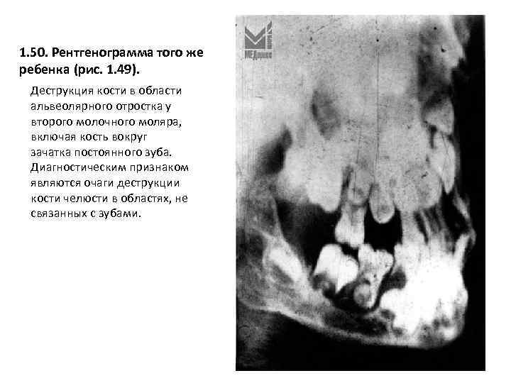 1. 50. Рентгенограмма того же ребенка (рис. 1. 49). Деструкция кости в области альвеолярного
