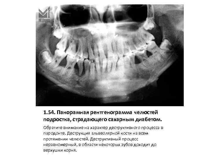 1. 54. Панорамная рентгенограмма челюстей подростка, страдающего сахарным диабетом. Обратите внимание на характер деструктивного