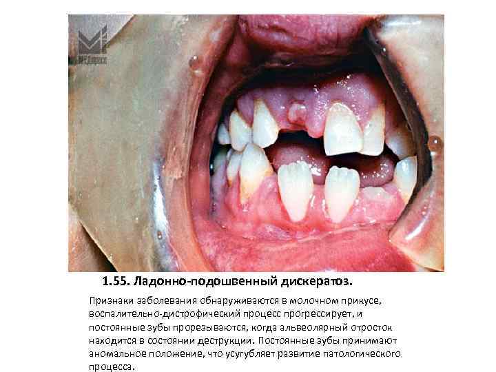 1. 55. Ладонно-подошвенный дискератоз. Признаки заболевания обнаруживаются в молочном прикусе, воспалительно-дистрофический процесс прогрессирует, и