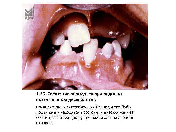 1. 56. Состояние пародонта при ладонноподошвенном дискератозе. Воспалительно-дистрофический пародонтит. Зубы подвижны и находятся в