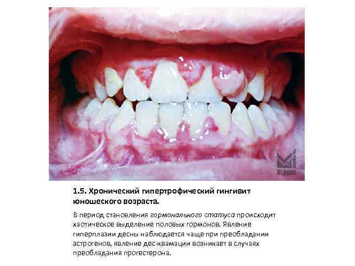 1. 5. Хронический гипертрофический гингивит юношеского возраста. В период становления гормонального статуса происходит хаотическое